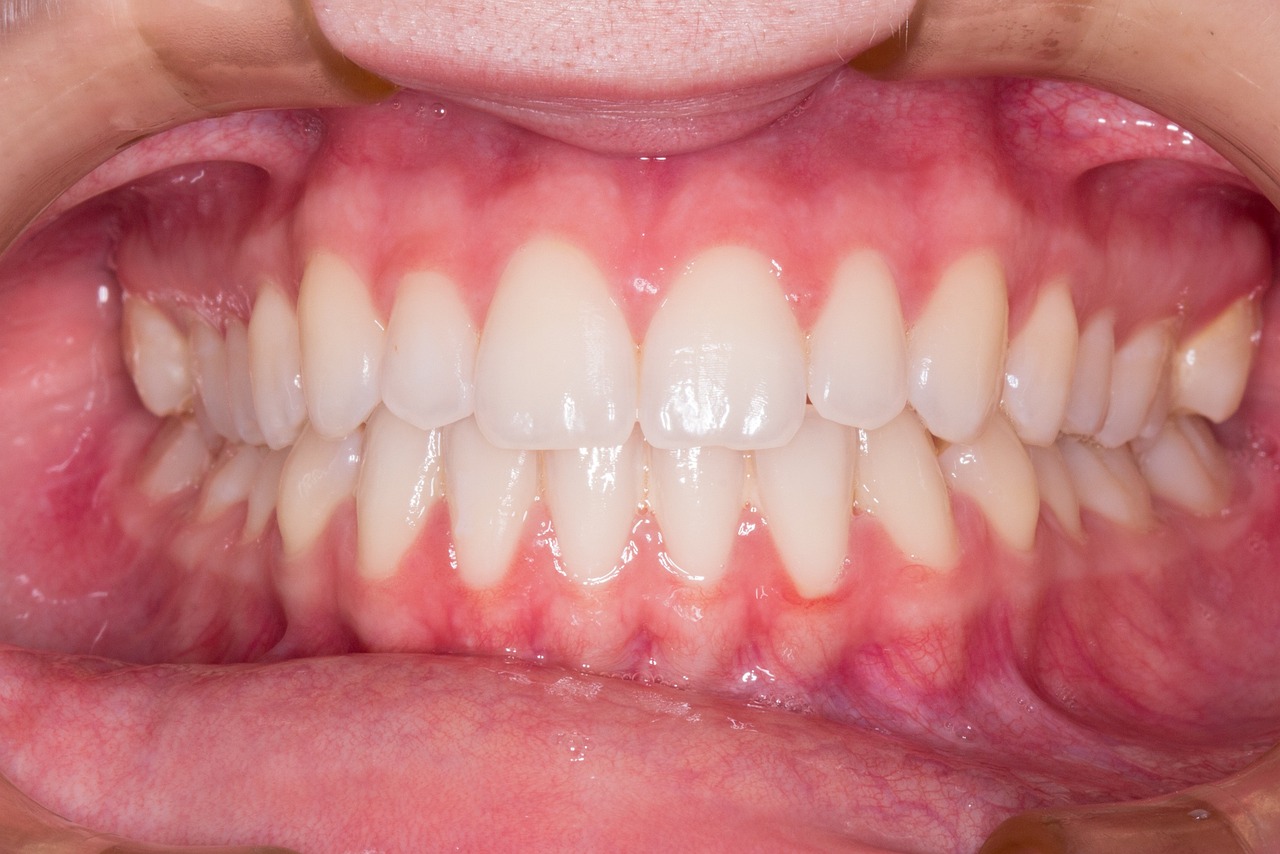 Ankara invisalign tedavisi