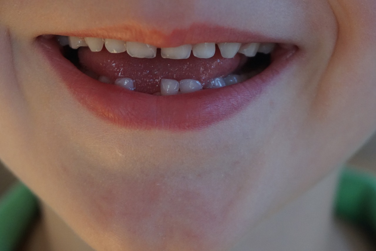 Ayrık dişler invisalign tedavisi ile düzelir mi?