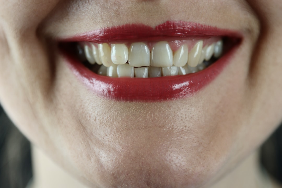 İnvisalign ile çarpık diş tedavisi